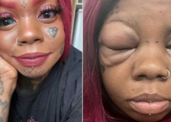 Após tatuar globo ocular de azul e roxo, mulher diz estar com risco de perder a visão