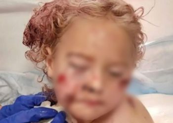 Uma criança de apenas 5 anos foi brutalmente atacada por um cachorro enquanto passeava com a mãe em um parque em Fort Lauderdale, na Flórida.