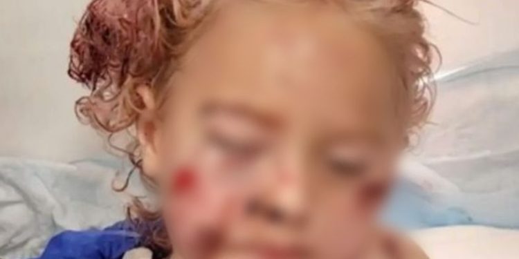 Uma criança de apenas 5 anos foi brutalmente atacada por um cachorro enquanto passeava com a mãe em um parque em Fort Lauderdale, na Flórida.