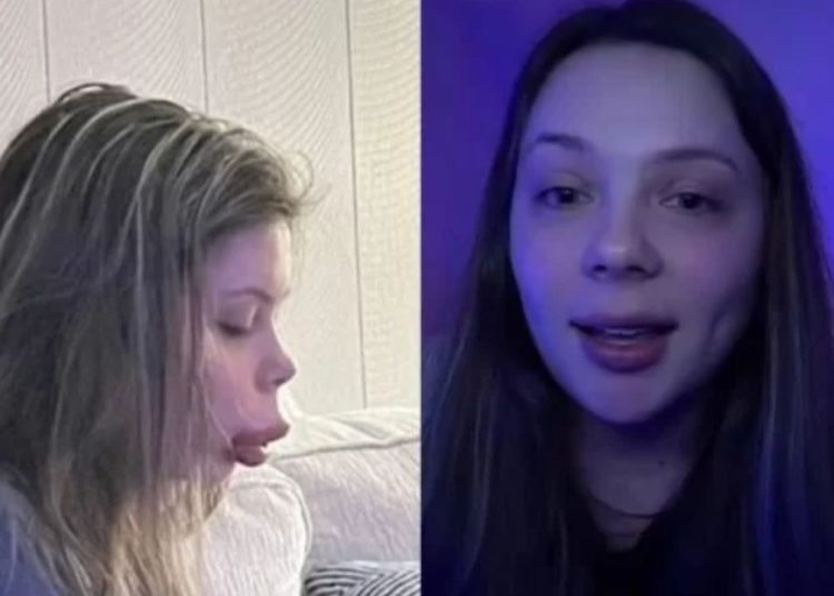Uma jovem viralizou ao mostrar o resultado desastroso de um preenchimento labial 'barato', depois de uma reação alérgica às injeções.