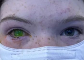 Doença rara que deixa olhos verdes apavoram população