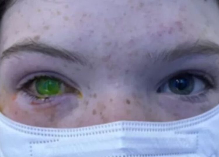 Doença rara que deixa olhos verdes apavoram população