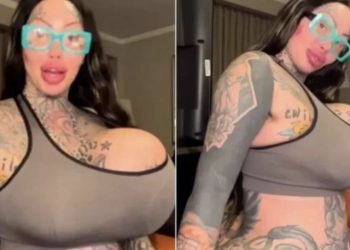 Prótese de silicone ‘explode’ e influencer exibe resultado chocante