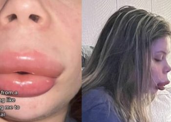 Reação alérgica a preenchimento labial deixa mulher com ‘boca de pato’