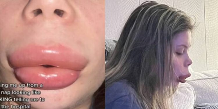 Reação alérgica a preenchimento labial deixa mulher com ‘boca de pato’