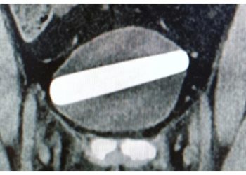 Uma mulher precisou passar por uma cirurgia para retirar um vibrador de cristal de sua bexiga após inserir o objeto de 10 centímetros.