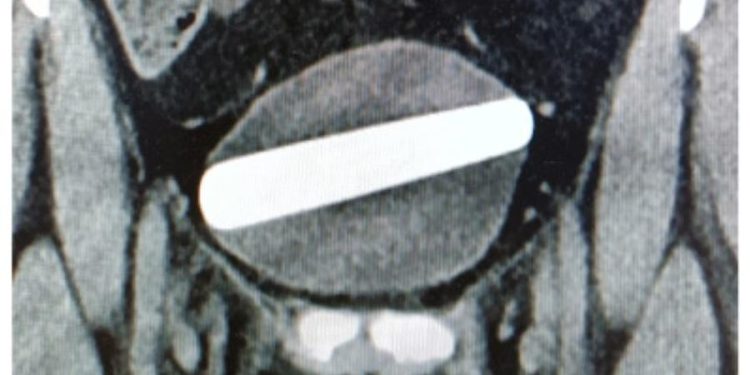 Uma mulher precisou passar por uma cirurgia para retirar um vibrador de cristal de sua bexiga após inserir o objeto de 10 centímetros.