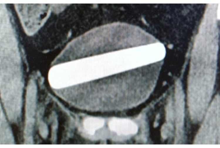 Uma mulher precisou passar por uma cirurgia para retirar um vibrador de cristal de sua bexiga após inserir o objeto de 10 centímetros.
