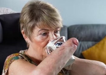 Uma mulher britânica de 61 anos estava à espera de um transplante duplo de mãos por mais ou menos seis anos.