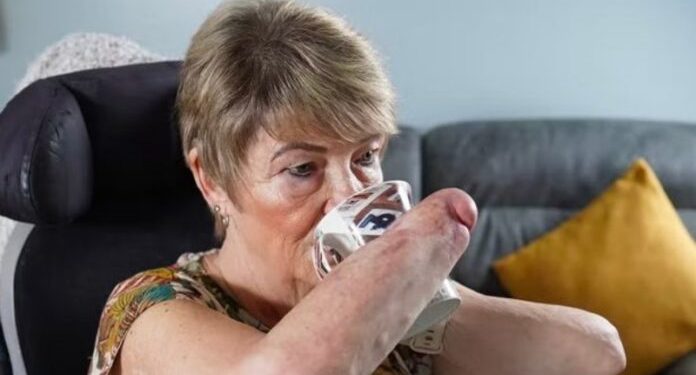 Uma mulher britânica de 61 anos estava à espera de um transplante duplo de mãos por mais ou menos seis anos.