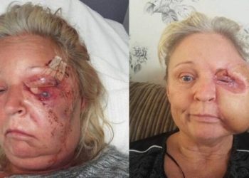 Uma mulher de 51 anos perdeu metade do rosto e quase morreu ao ser infectada por bactérias comedoras de carne.