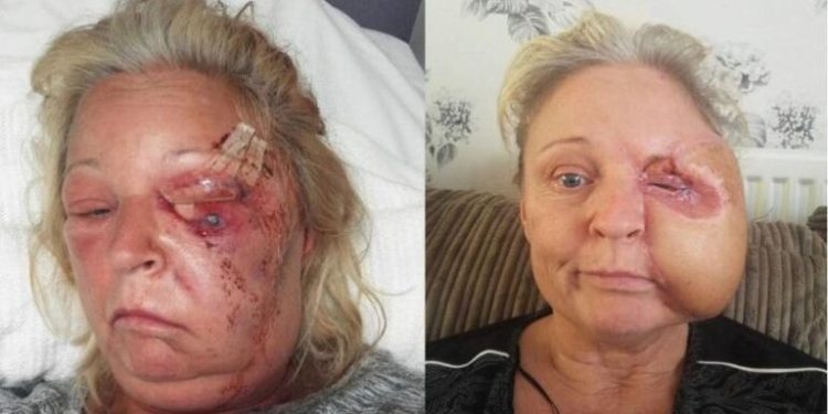 Uma mulher de 51 anos perdeu metade do rosto e quase morreu ao ser infectada por bactérias comedoras de carne.