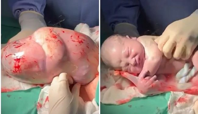 O pequeno Guilherme Auak, filho da dona de casa Katia Sousa, chegou ao mundo de uma forma única, ele nasceu empelicado em uma. Vídeo: