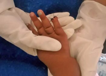 Uma bebê de 1 ano teve parte do dedo mindinho direito amputado durante a retirada de um curativo no pronto-socorro de São Gonçalo.