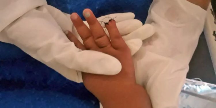Uma bebê de 1 ano teve parte do dedo mindinho direito amputado durante a retirada de um curativo no pronto-socorro de São Gonçalo.
