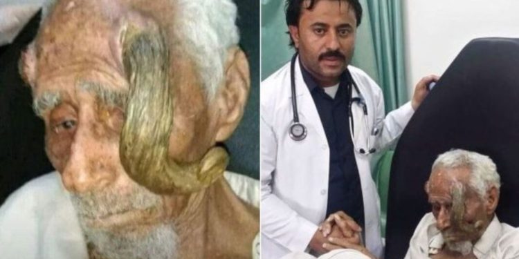 Um idoso de 140 anos, faleceu depois de uma cirurgia para remover protuberâncias retorcidas que se assemelhavam a chifres.