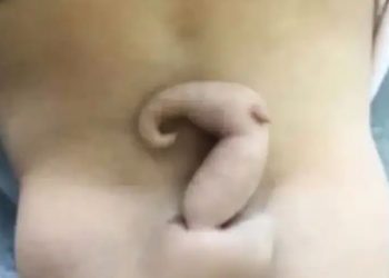 No Brasil, uma bebê nasceu com uma cauda de aproximadamente 6 centímetros. Dentro da obstetrícia, o acontecimento é considerado bastante raro.