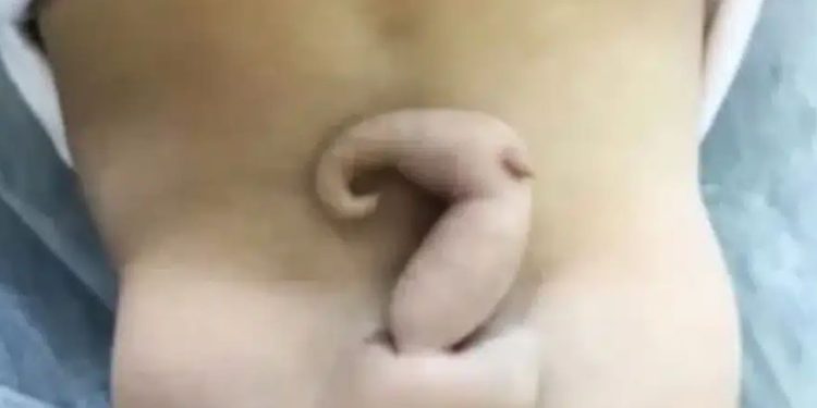 No Brasil, uma bebê nasceu com uma cauda de aproximadamente 6 centímetros. Dentro da obstetrícia, o acontecimento é considerado bastante raro.