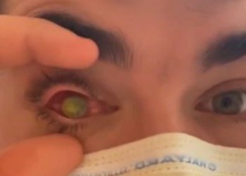 Homem tem olho devorado por parasita carnívoro e fica cego após dormir com lentes de contato