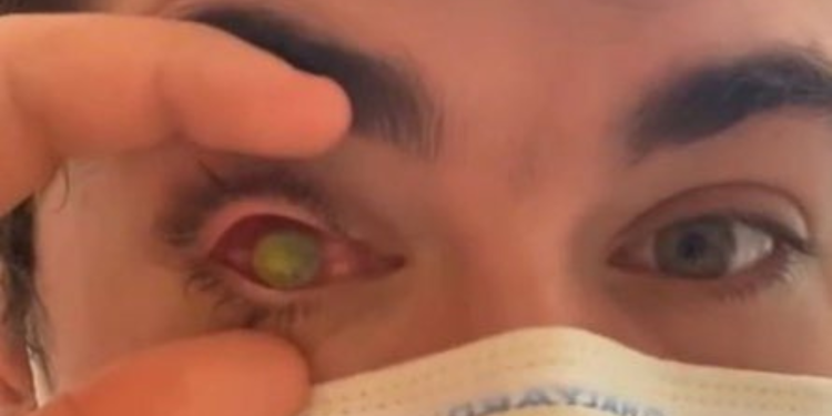 Homem tem olho devorado por parasita carnívoro e fica cego após dormir com lentes de contato