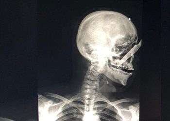 Um jovem amazonense foi atingido com um faca na região do rosto na última sexta-feira (17) no município de Carauari, interior do Amazonas. 