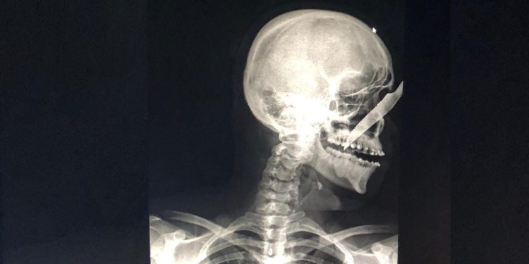 Um jovem amazonense foi atingido com um faca na região do rosto na última sexta-feira (17) no município de Carauari, interior do Amazonas. 