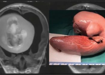 Uma criança chinesa de 1 ano passou por uma cirurgia delicada para retirar o feto de seu irmão gêmeo do cérebro.