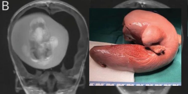 Uma criança chinesa de 1 ano passou por uma cirurgia delicada para retirar o feto de seu irmão gêmeo do cérebro.