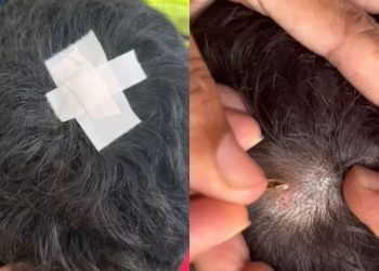 Um vídeo compartilhado pela mãe do garoto mostra o momento em que ela retira uma larva da cabeça da criança com uma pinça.