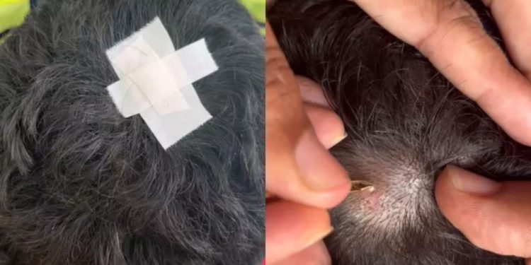 Um vídeo compartilhado pela mãe do garoto mostra o momento em que ela retira uma larva da cabeça da criança com uma pinça.