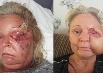 A britânica Donna Corden, de 51 anos, mãe de cinco filhos, perdeu metade do rosto e quase morreu após ter sido infectada. Mulher perde.