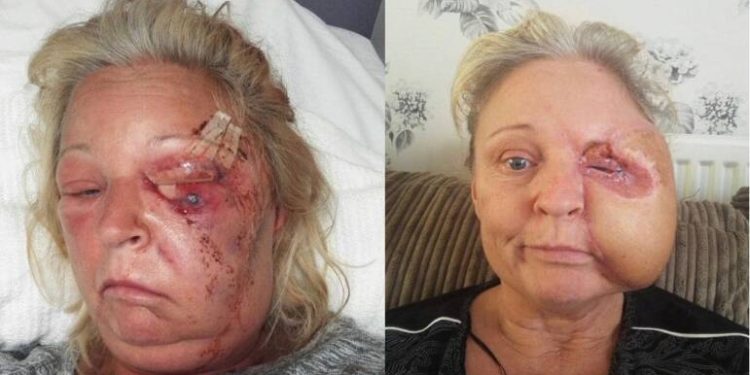 A britânica Donna Corden, de 51 anos, mãe de cinco filhos, perdeu metade do rosto e quase morreu após ter sido infectada. Mulher perde.