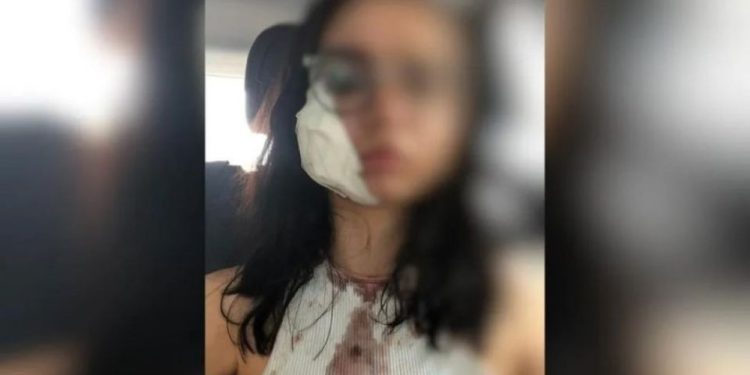 Uma jovem teve parte da bochecha arrancada após ser mordida pelo ex-namorado, no dia 20 de fevereiro, em Fortaleza, Ceará. Jovem tem