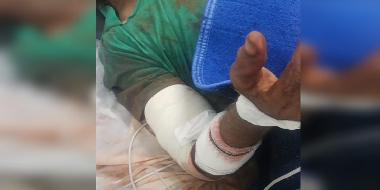 Um idoso de 62 anos teve a perna amputada após ser atacado por cães na noite de segunda-feira (6), em Severínia (SP). Idoso tem.