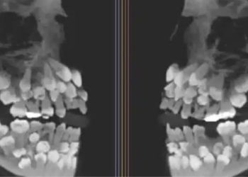 Menina de 11 anos surpreende ao ter 81 dentes