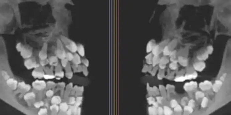 Menina de 11 anos surpreende ao ter 81 dentes