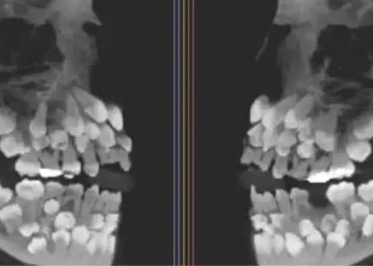 Menina de 11 anos surpreende ao ter 81 dentes