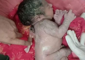 Bebê nasce com 3° braço nas costas em hospital e surpreende família