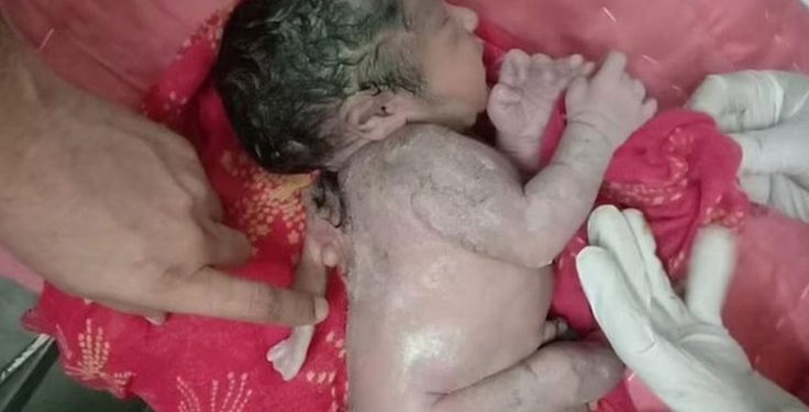 Bebê nasce com 3° braço nas costas em hospital e surpreende família