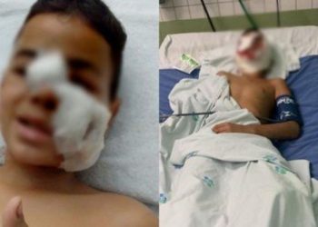 Uma criança de 10 anos foi atacada por um cachorro, da raça pit bull, e teve a orelha decepada, além de ferimentos. Criança de