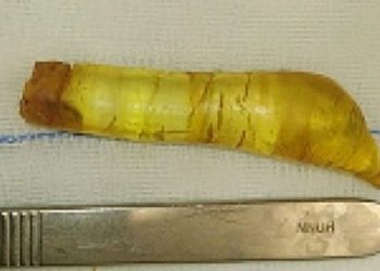 Um homem de 60 anos foi parar na emergência de um hospital na Palestina após injetar na própria uretra um gel de silicone. Idoso vai