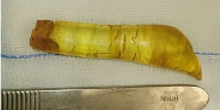 Um homem de 60 anos foi parar na emergência de um hospital na Palestina após injetar na própria uretra um gel de silicone. Idoso vai