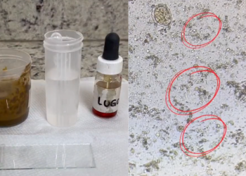Laboratório encontra espermatozoide durante exame de fezes de paciente