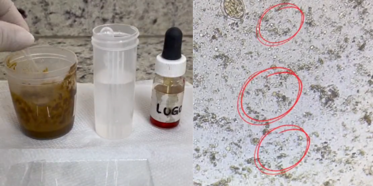 Laboratório encontra espermatozoide durante exame de fezes de paciente