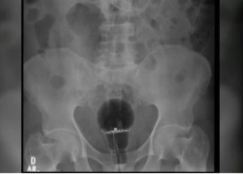 Um homem de 53 anos foi parar no hospital após sentir muita dor no ânus. A princípio, os médicos não sabiam do que se. Homem enfia