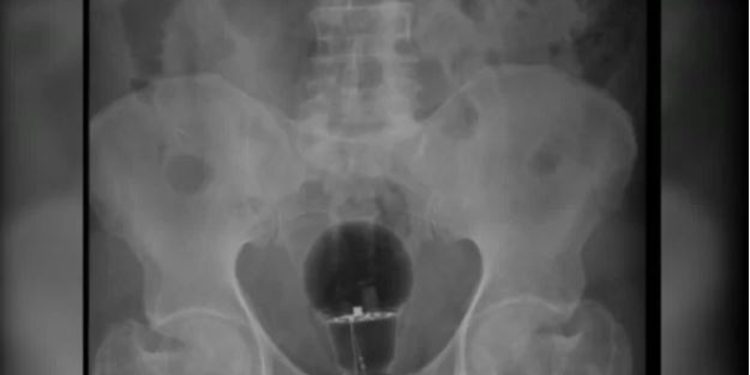 Um homem de 53 anos foi parar no hospital após sentir muita dor no ânus. A princípio, os médicos não sabiam do que se. Homem enfia