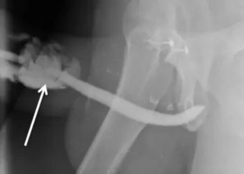 Uma posição sexual perigosa fez um morador da Tanzania de 36 anos, quebrar o 'bilau' em 3 lugares diferentes.