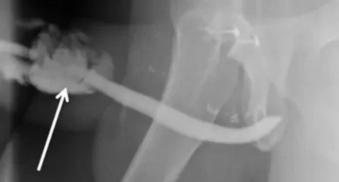 Uma posição sexual perigosa fez um morador da Tanzania de 36 anos, quebrar o 'bilau' em 3 lugares diferentes.