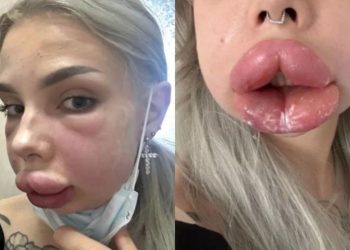 Influenciadora escapa da morte e fica deformada após reação a procedimento labial