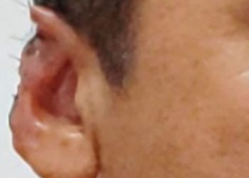 Para reatar namoro, homem finge sequestro e corta as próprias orelhas